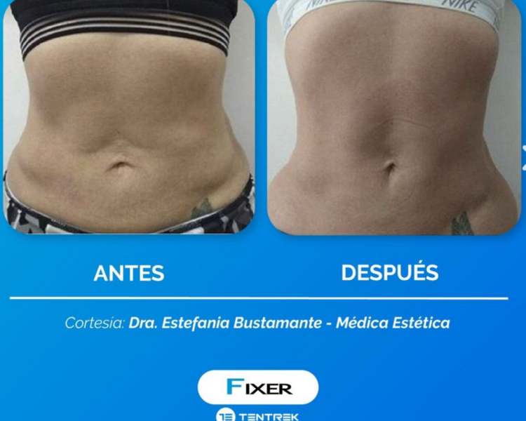 fixer radiofrecuencia fraccionada 