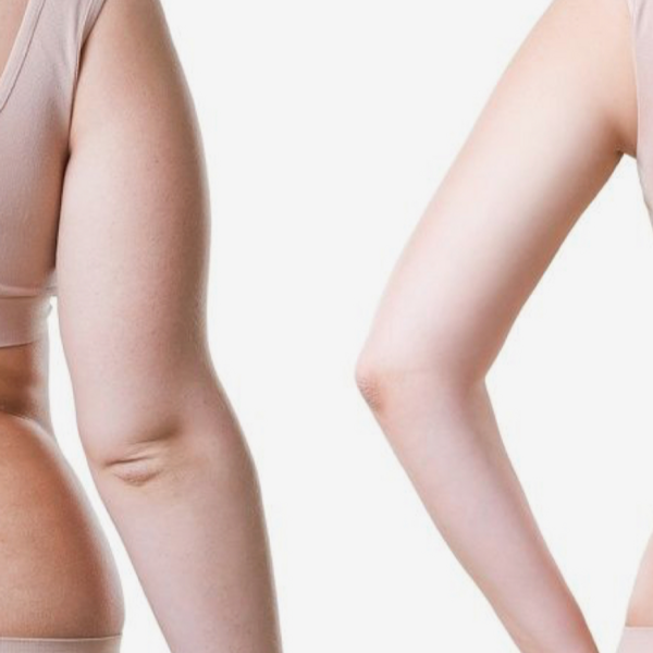 Reducción y tonificación de brazos 